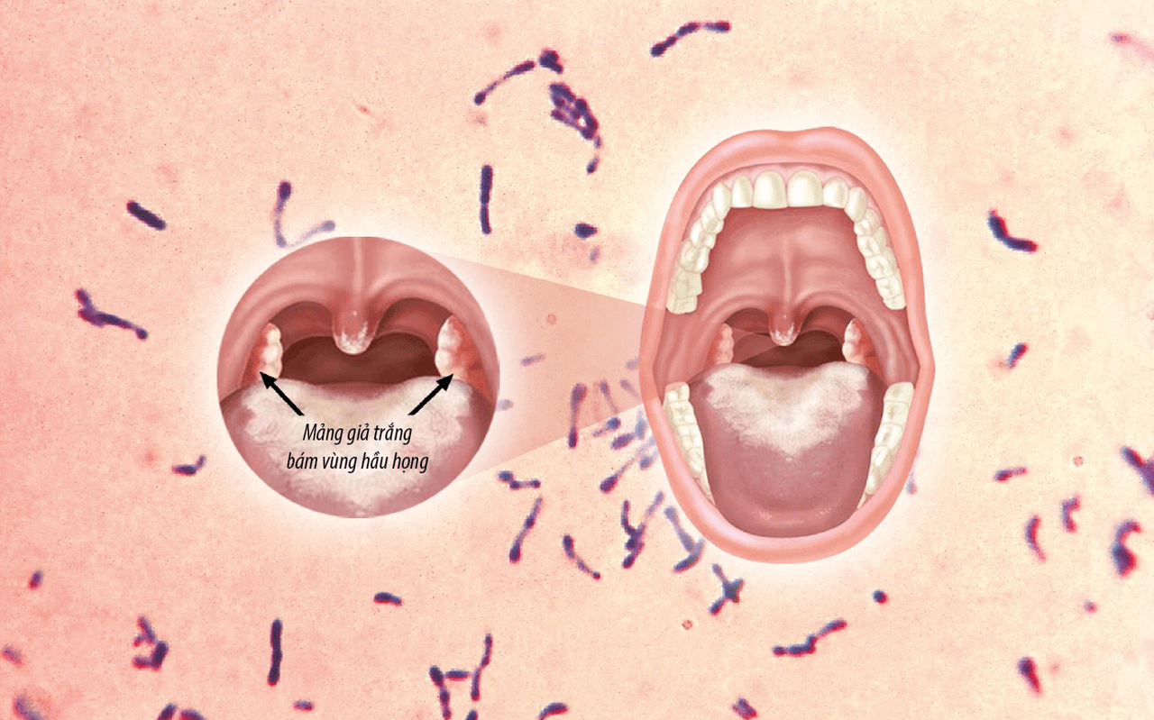 vi khuẩn Corynebacterium diphtheriae, nguyên nhân chính gây bệnh bạch hầu