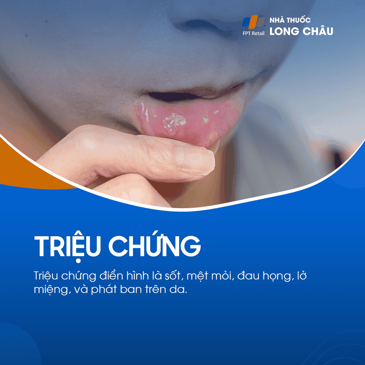 Bệnh tay, chân, miệng 2