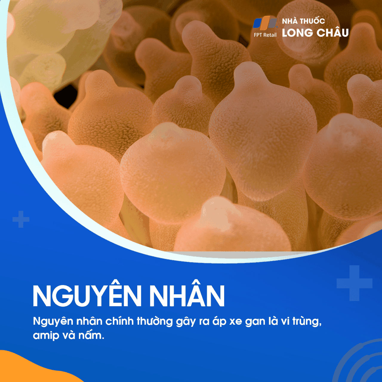 Nguyên nhân áp xe gan - Tác nhân gây nhiễm trùng và hình thành mủ trong gan