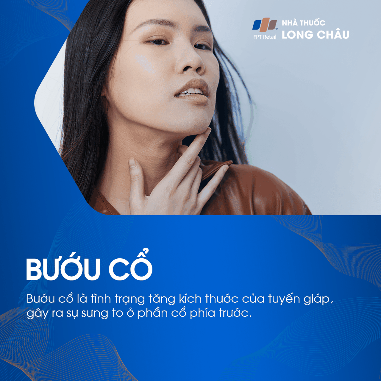 Bướu cổ là sự phì đại tuyến giáp gây sưng ở phần cổ trước