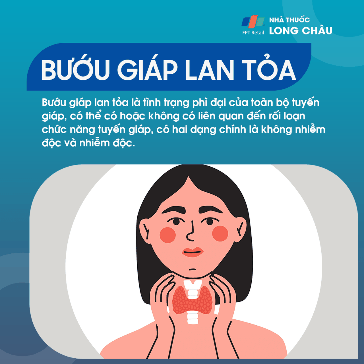 Bướu giáp lan tỏa 1
