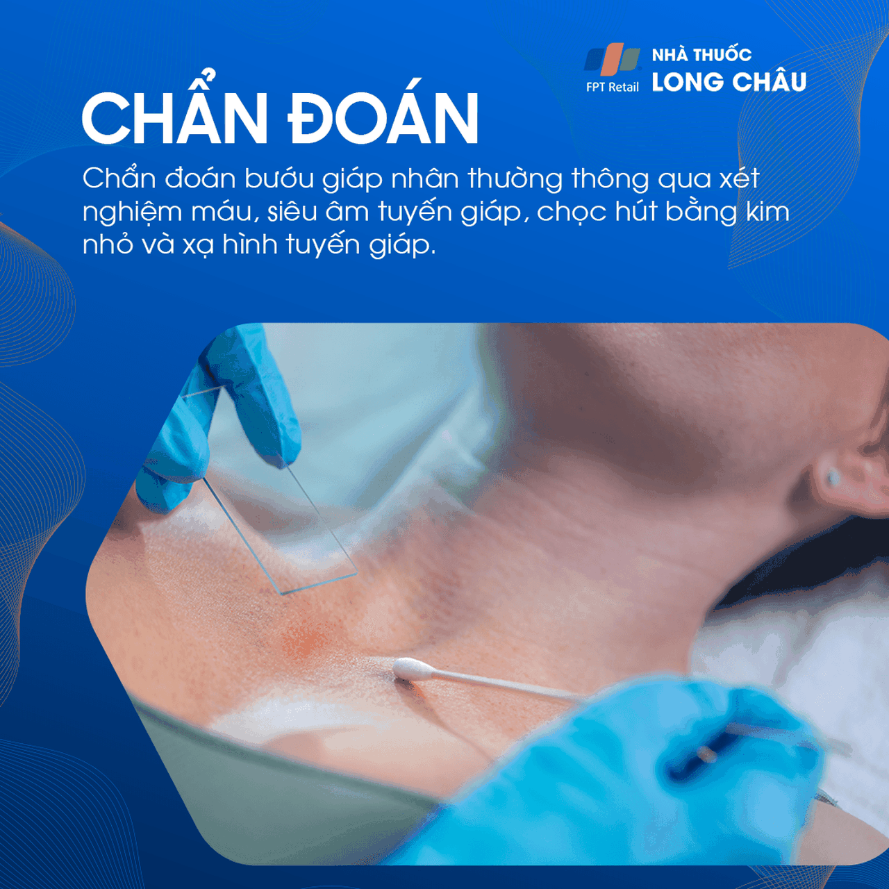 Bướu giáp nhân 5