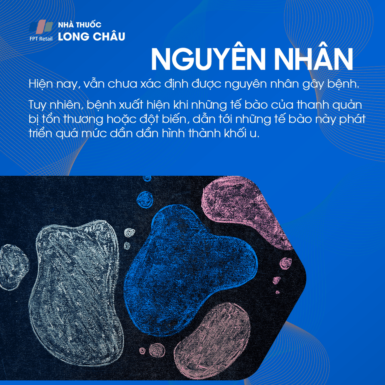 ung thư thanh quản 3