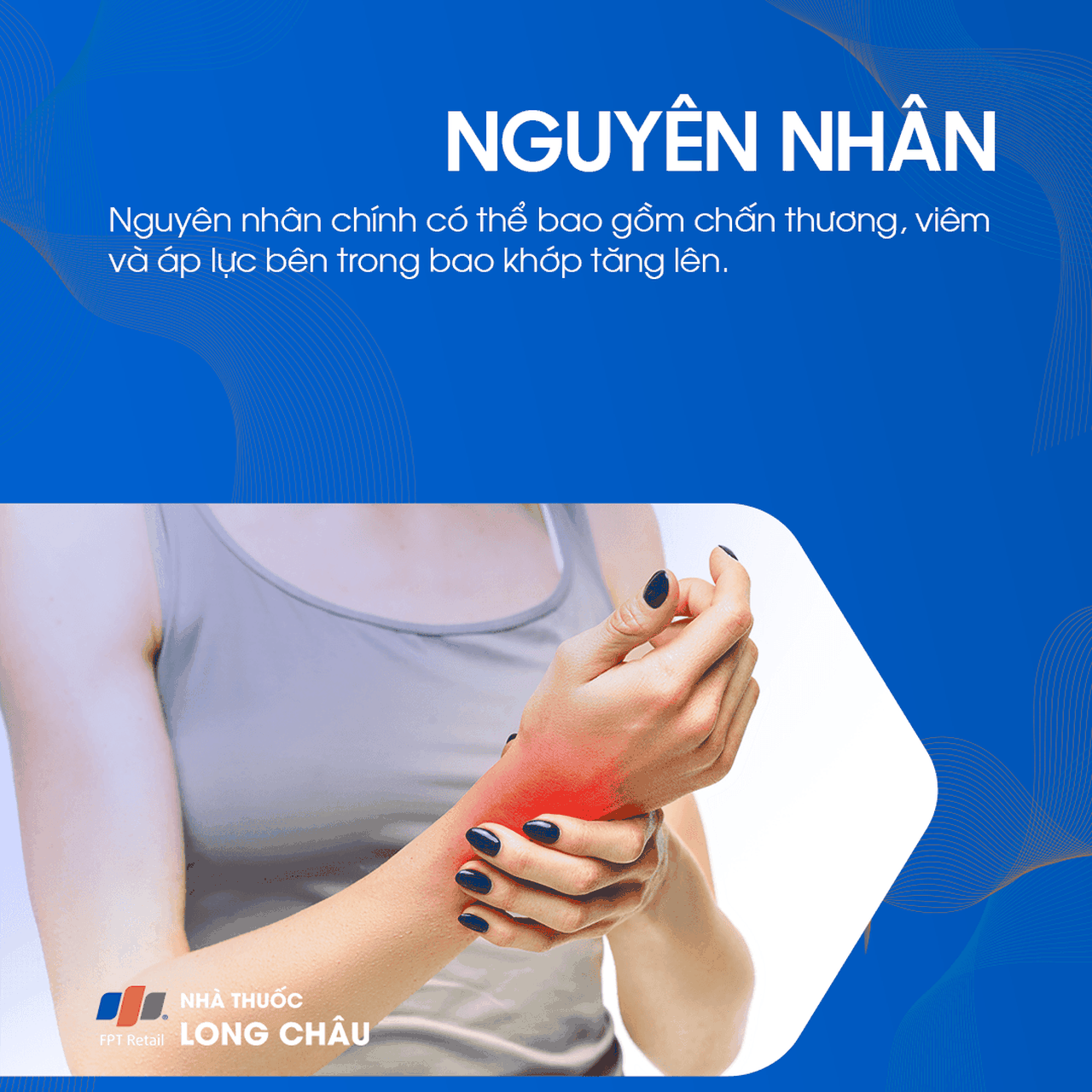 Bướu Hoạt Dịch Cổ Tay 3