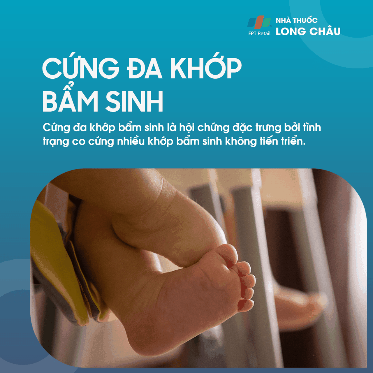 Cứng Đa Khớp Bẩm Sinh 1