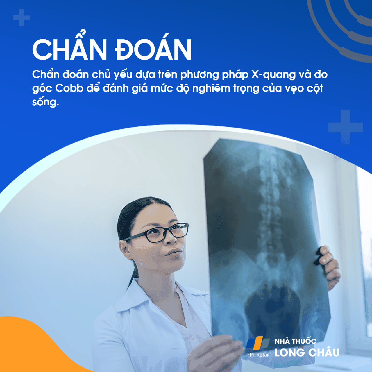 Vẹo Cột Sống Tự Phát 5