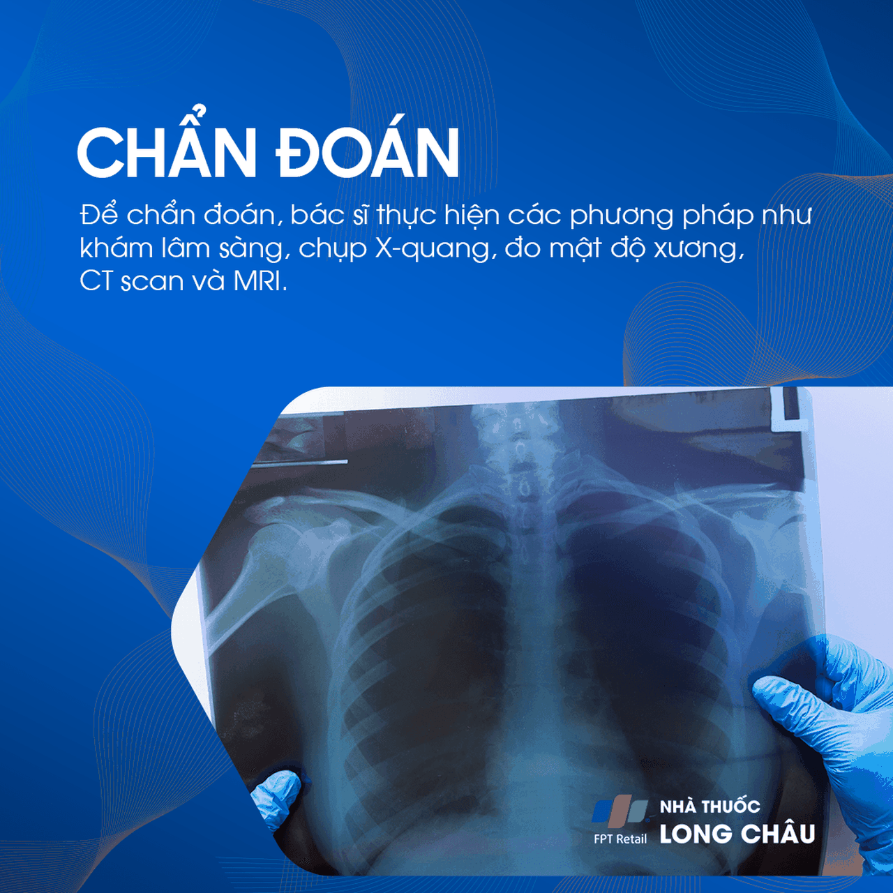 Xẹp Đốt Sống 5