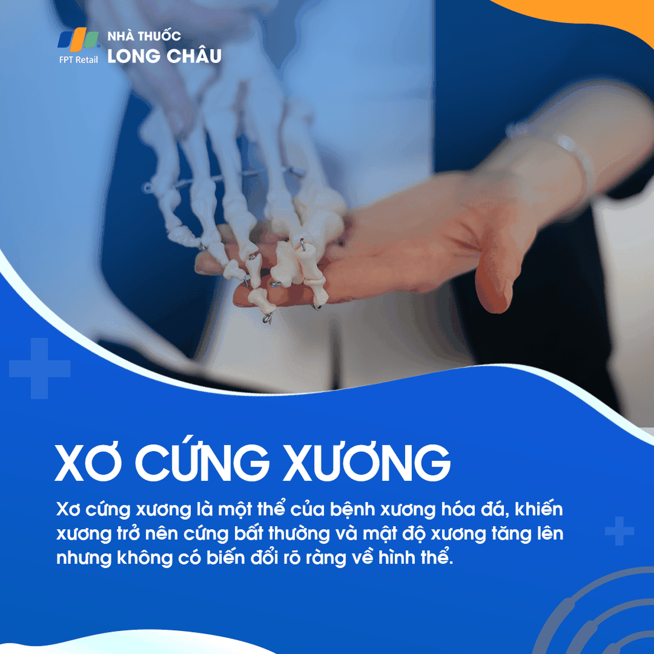 Xơ Cứng Xương 1