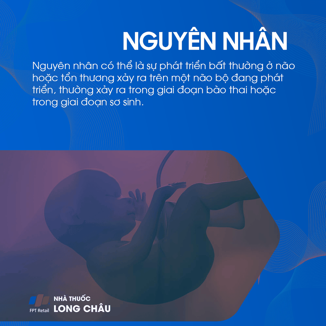 Nguyên nhân bại não là do bất thường phát triển hoặc tổn thương não trong thai kỳ hoặc sơ sinh