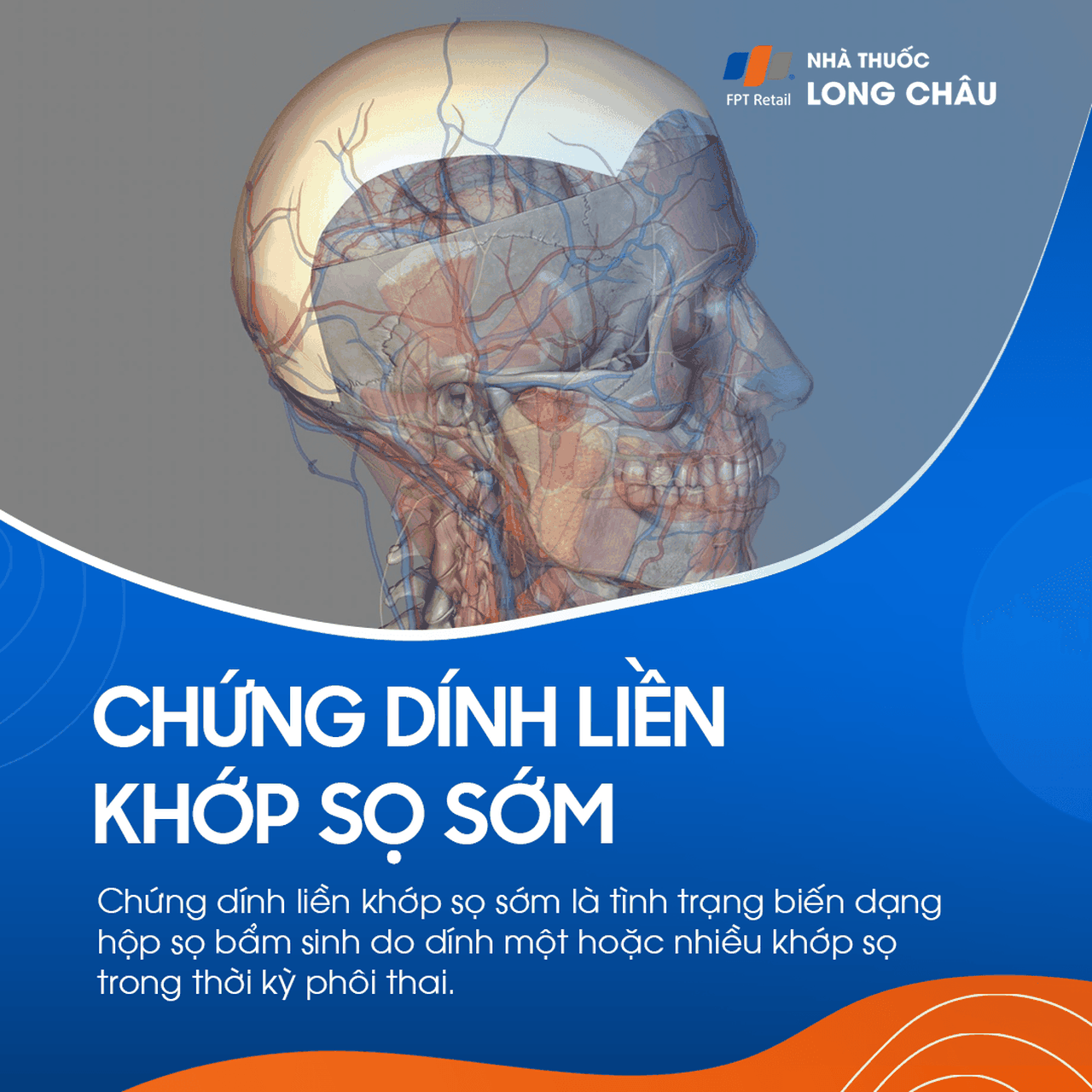 Chứng dính liền khớp sọ sớm 1