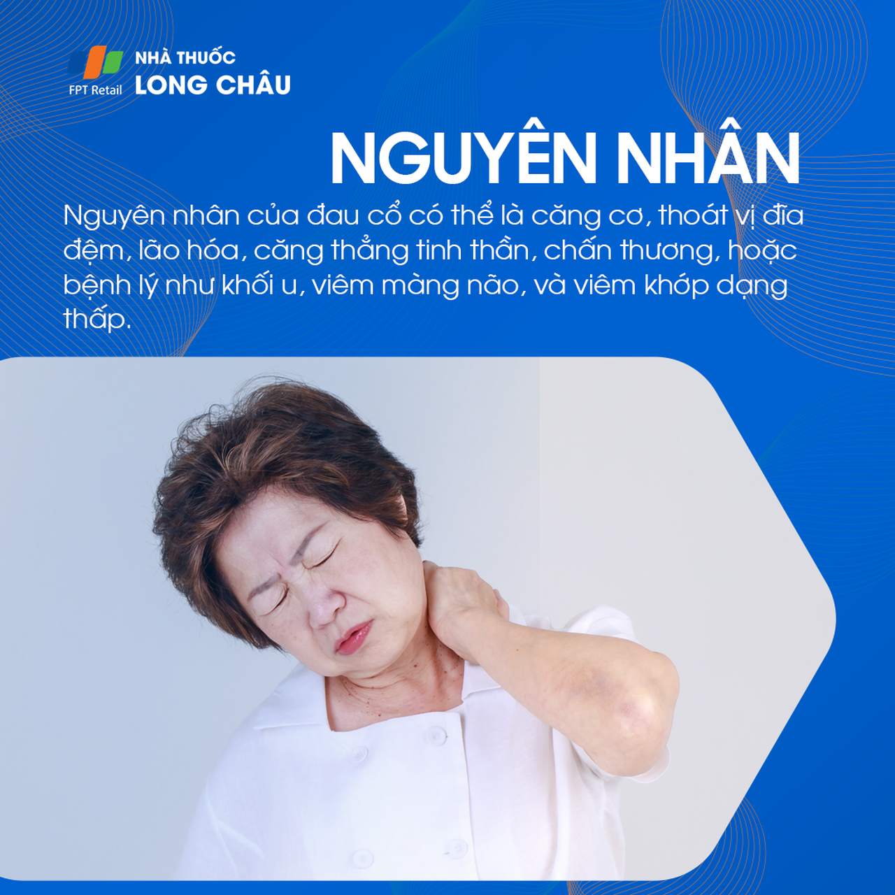 Nguyên nhân đau cổ: Đau cổ có thể do căng cơ, thoát vị đĩa đệm, lão hóa, căng thẳng tinh thần, chấn thương hoặc bệnh lý.