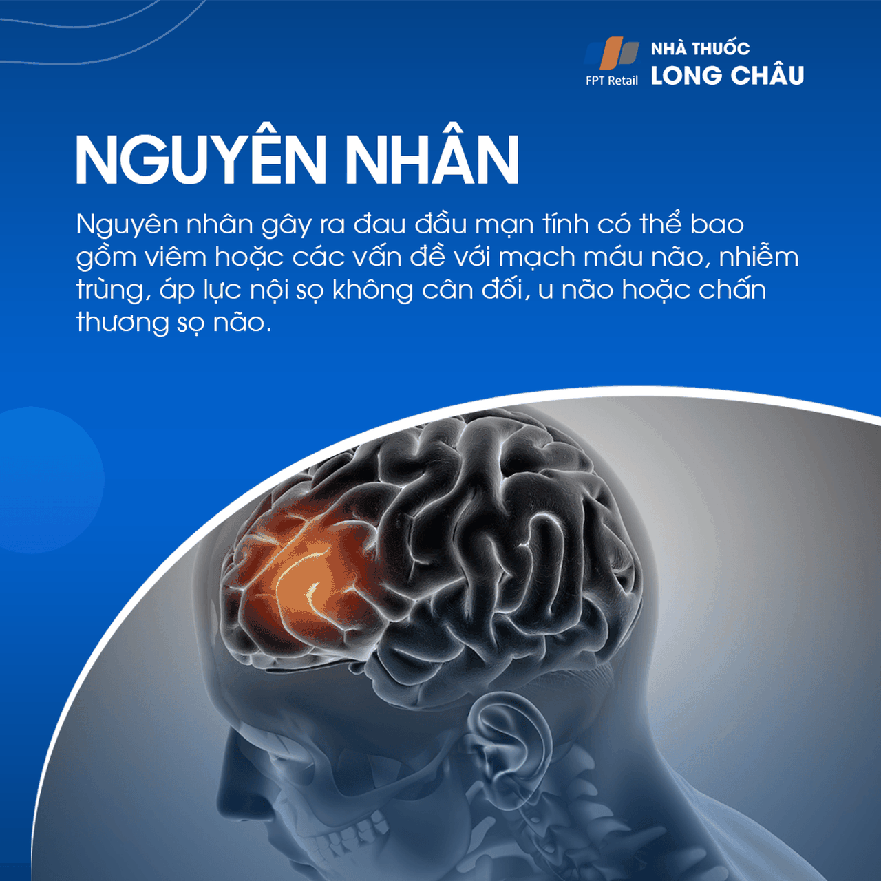 Đau đầu mạn tính 3