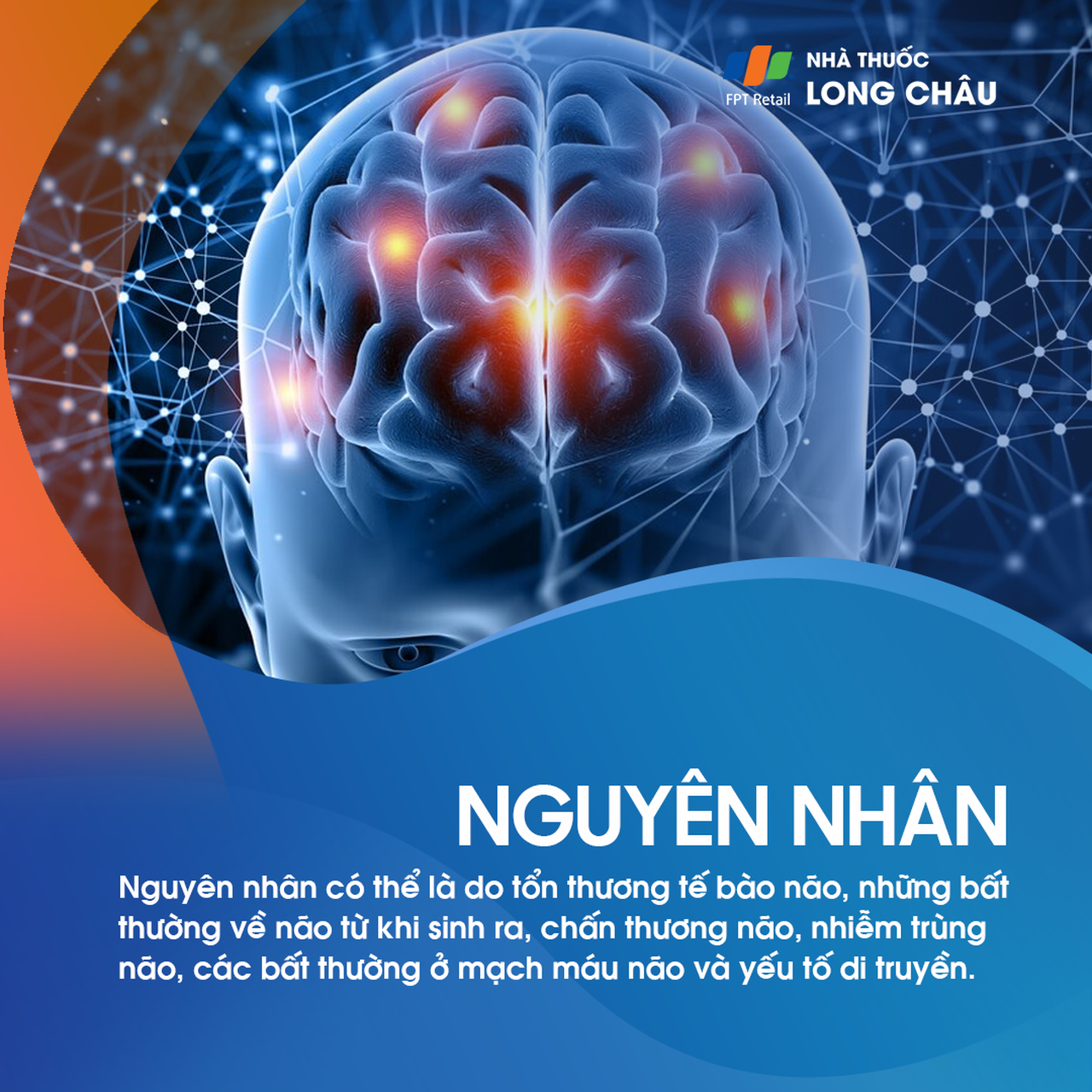 Động kinh thùy thái dương 4