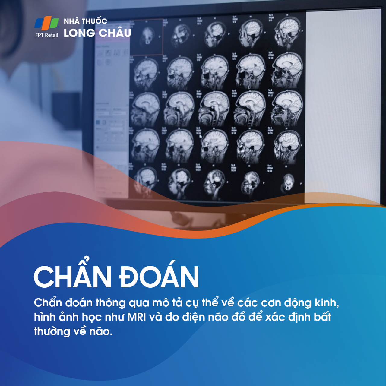 Động kinh thùy thái dương 6