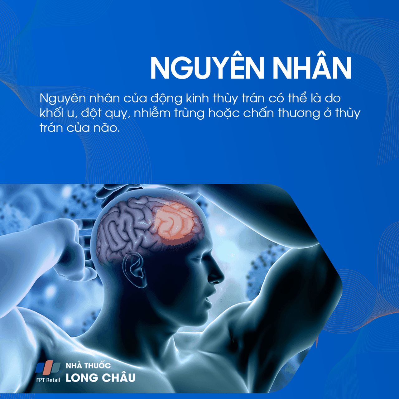 Động kinh thùy trán 3