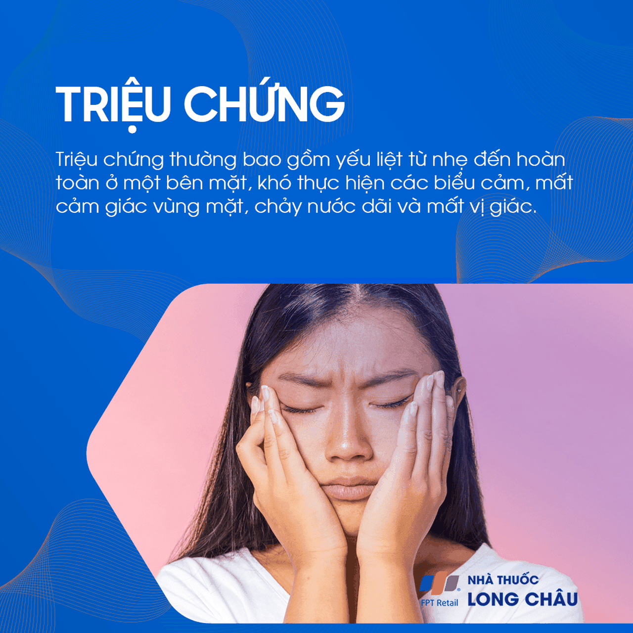 Liệt mặt ngoại biên 2