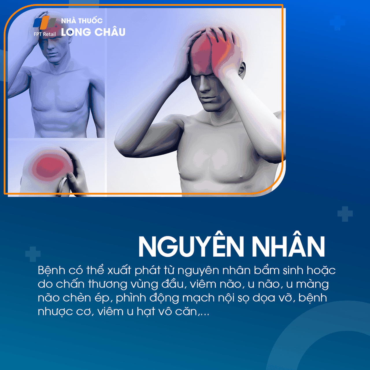 Liệt dây thần kinh số III 3