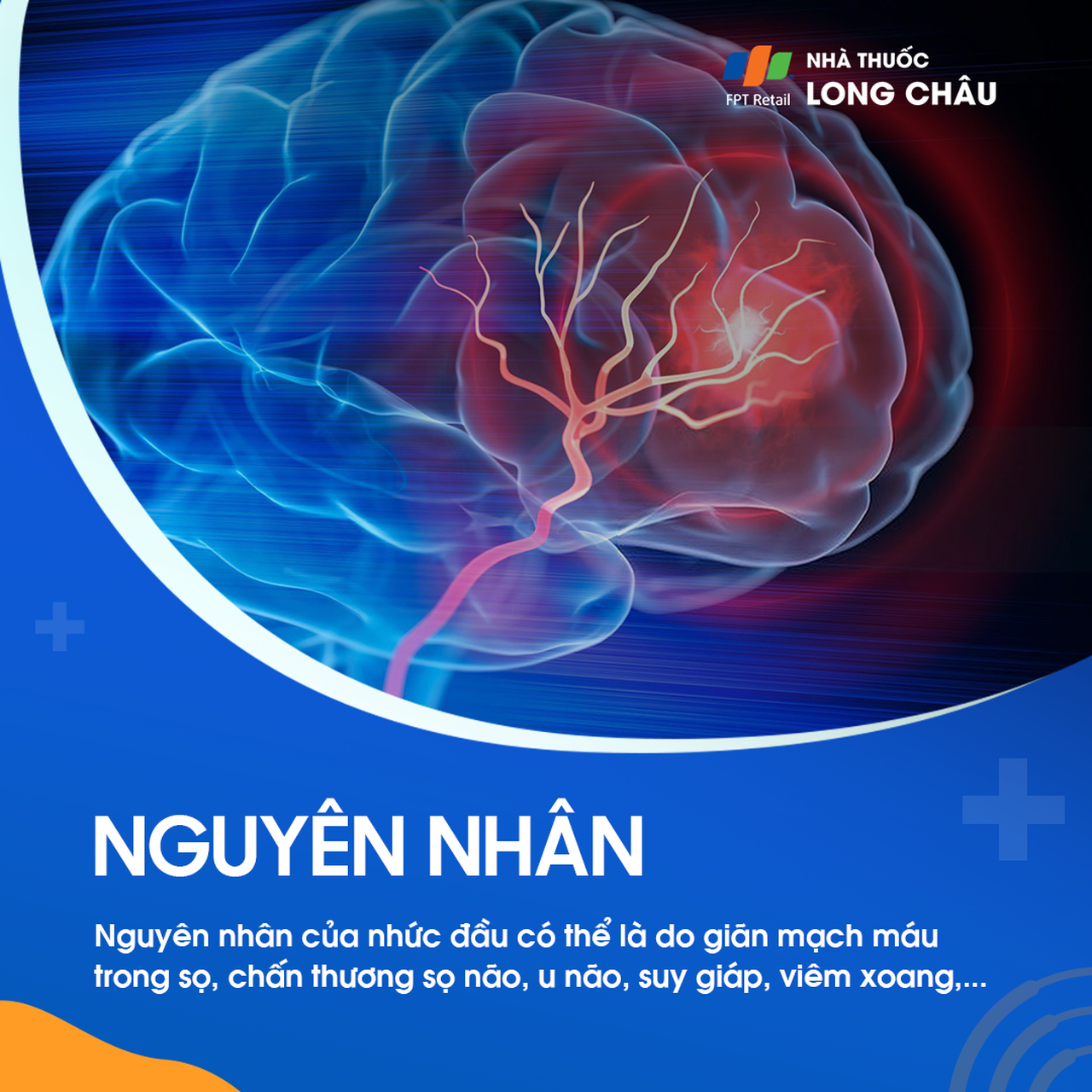 Căng thẳng, mất ngủ, thiếu nước, và các vấn đề về thị lực là những nguyên nhân 