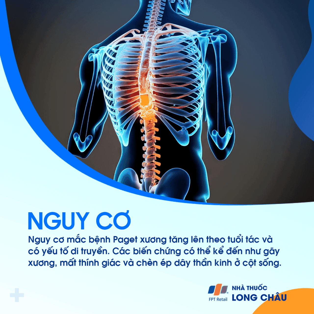 Paget xương 4