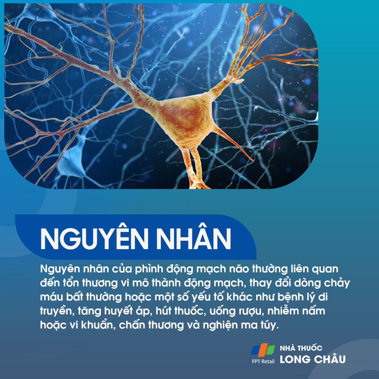 Phình động mạch não 3