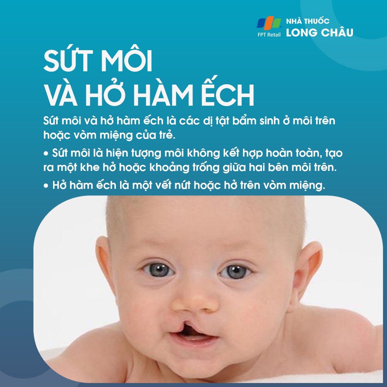 Sứt môi và hở hàm ếch 1