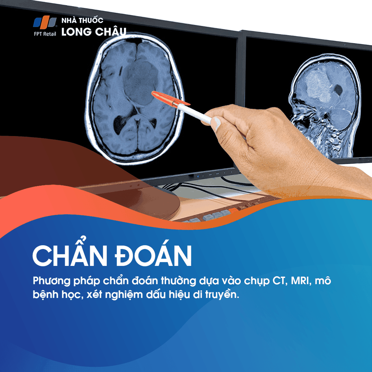 U tế bào thần kinh đệm ít nhánh 5