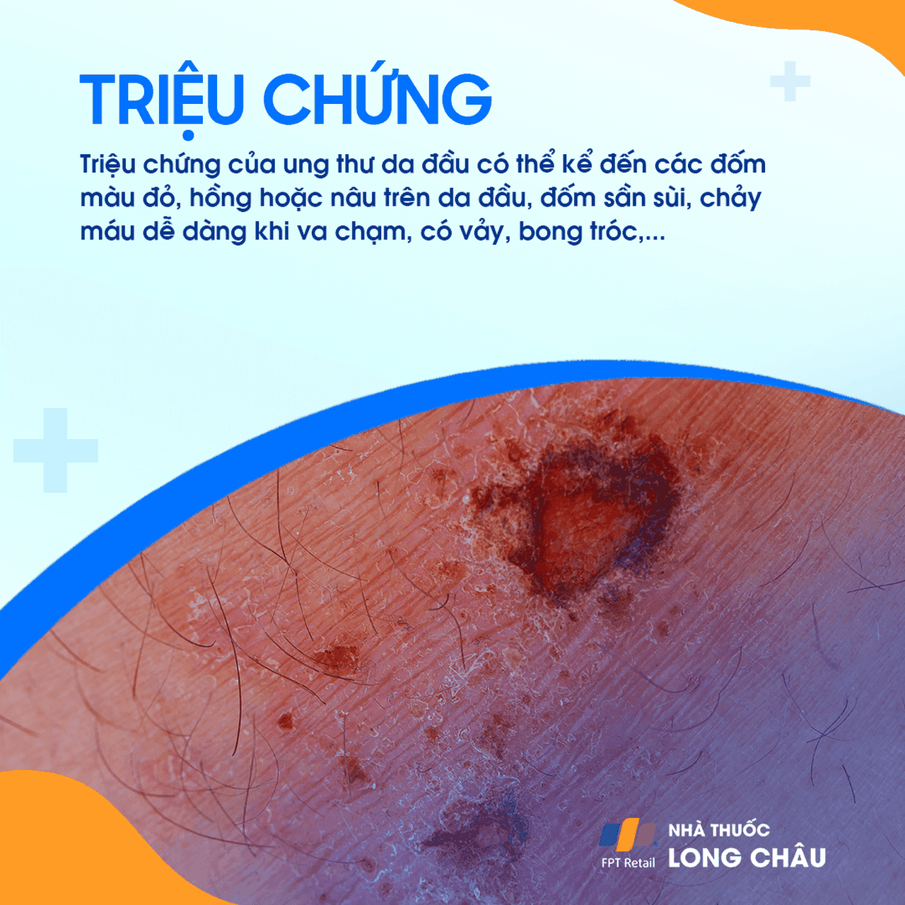 Ung thư da đầu 2