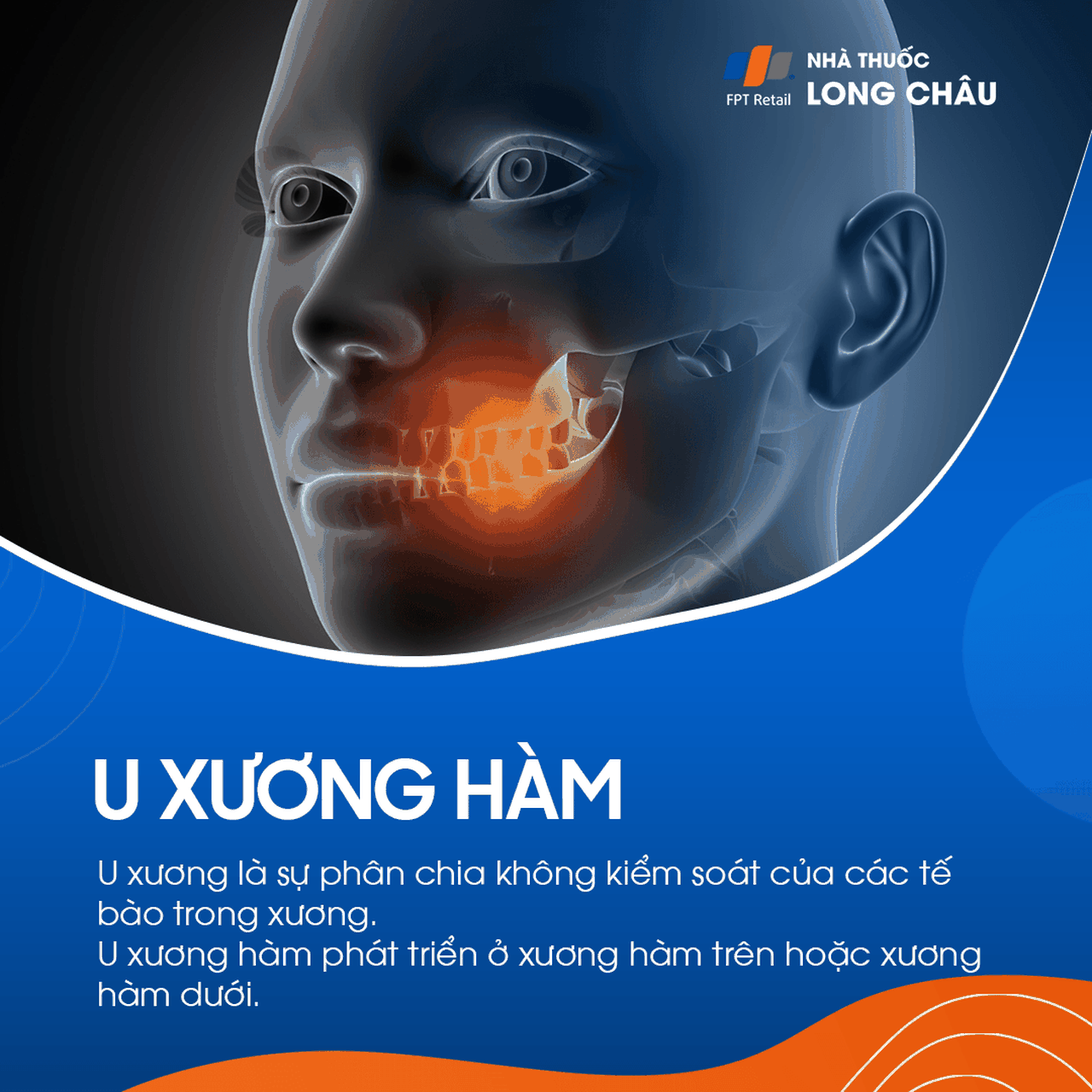 U xương hàm 1