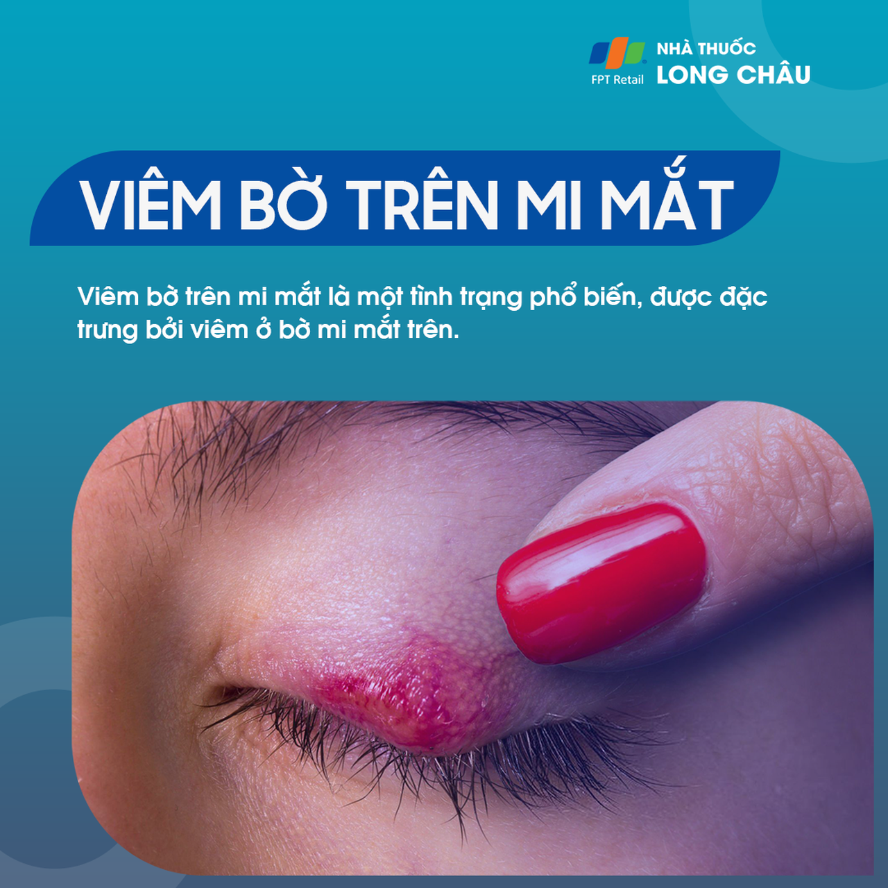  Viêm bờ trên mi mắt là gì? Nguyên nhân, triệu chứng và cách điều trị 1