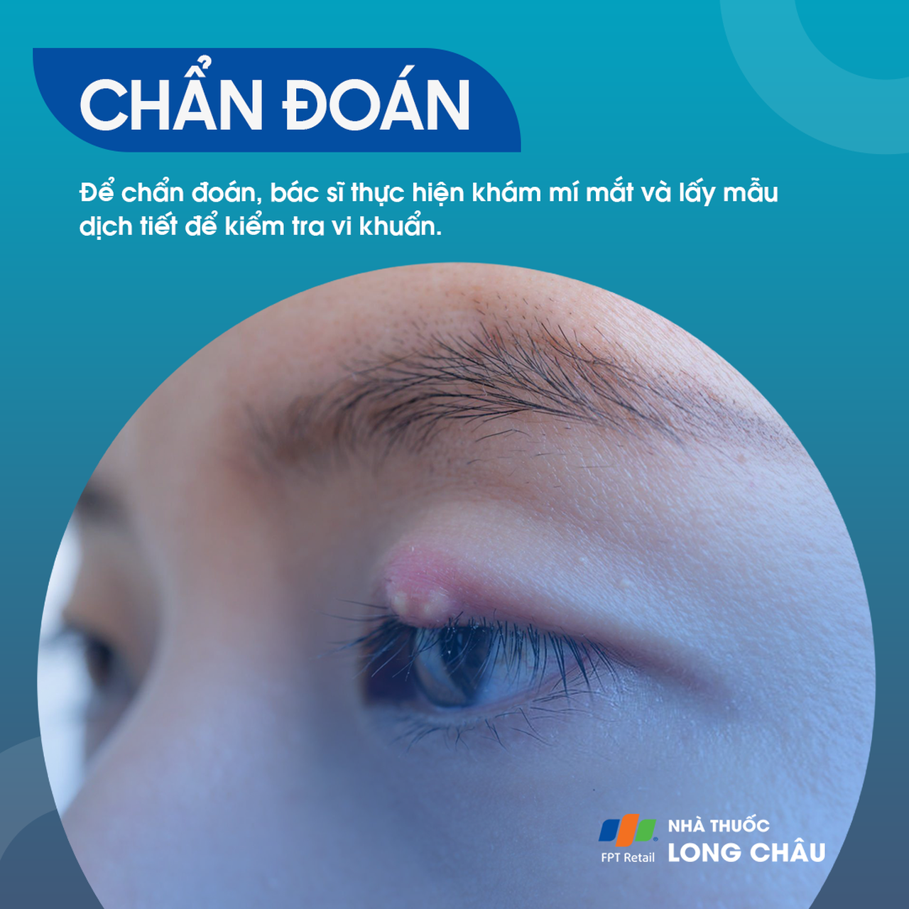  Viêm bờ trên mi mắt là gì? Nguyên nhân, triệu chứng và cách điều trị 5