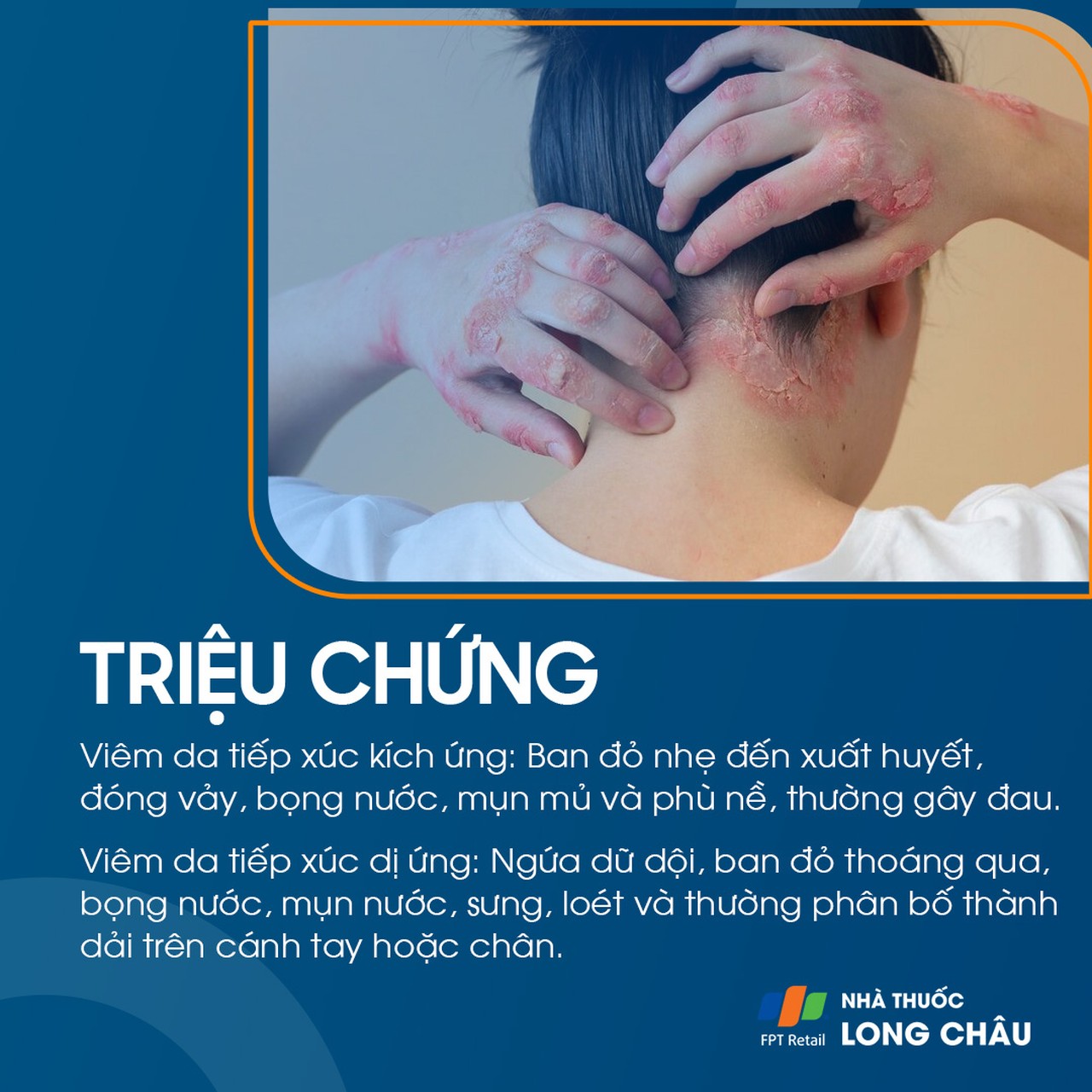 Triệu chứng viêm da do tiếp xúc với da đỏ, ngứa và phát ban