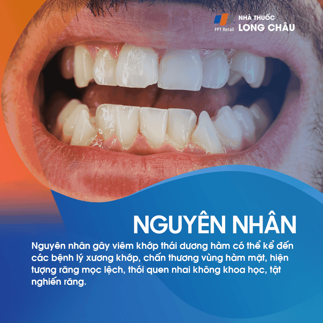 Viêm khớp thái dương hàm 3