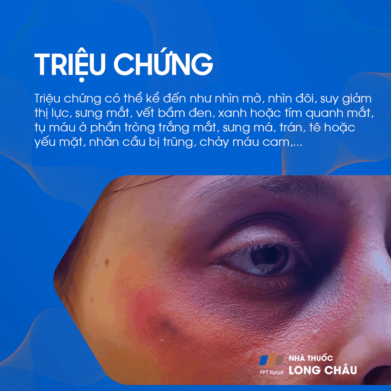 Vỡ xương hốc mắt 1