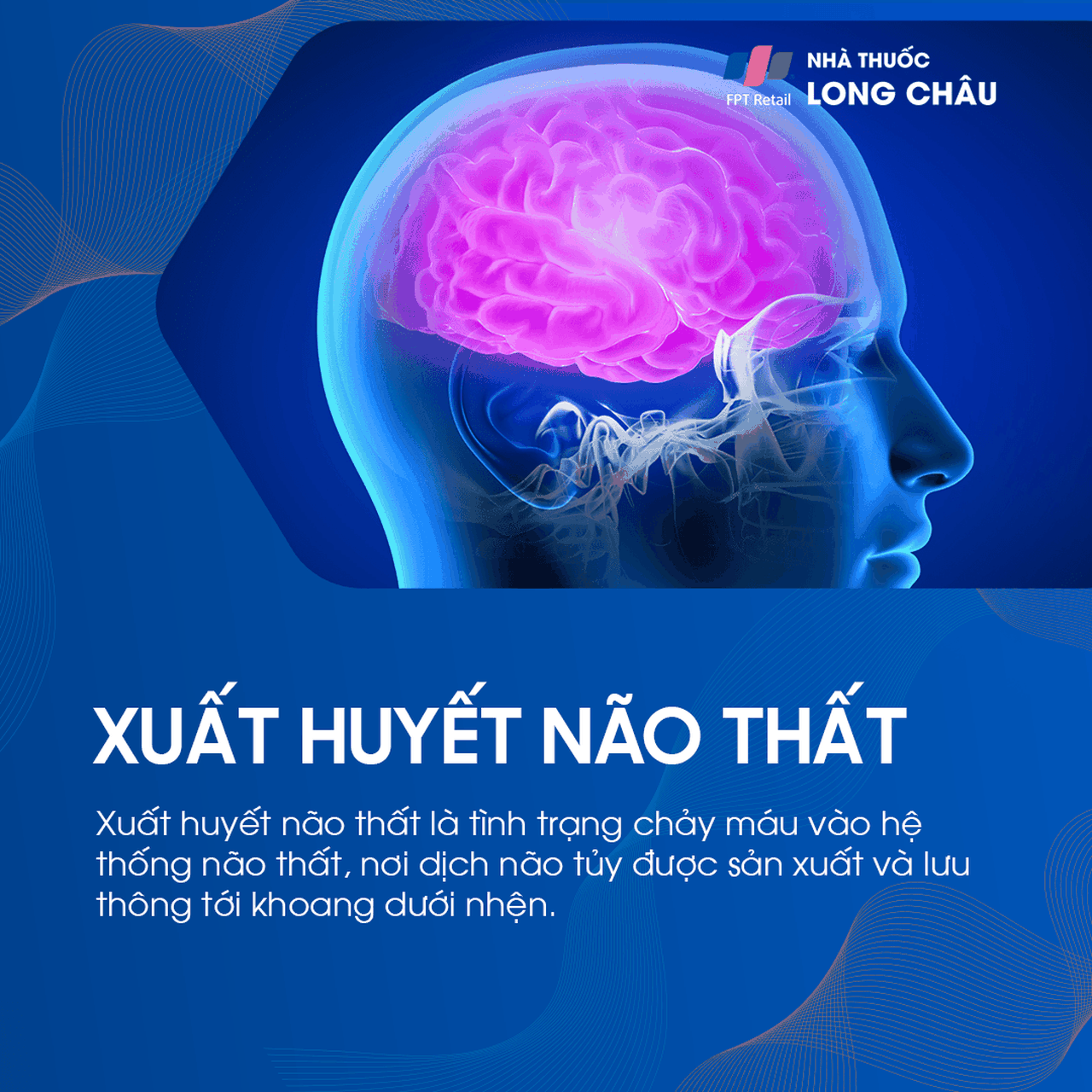 Xuất huyết não thất 1