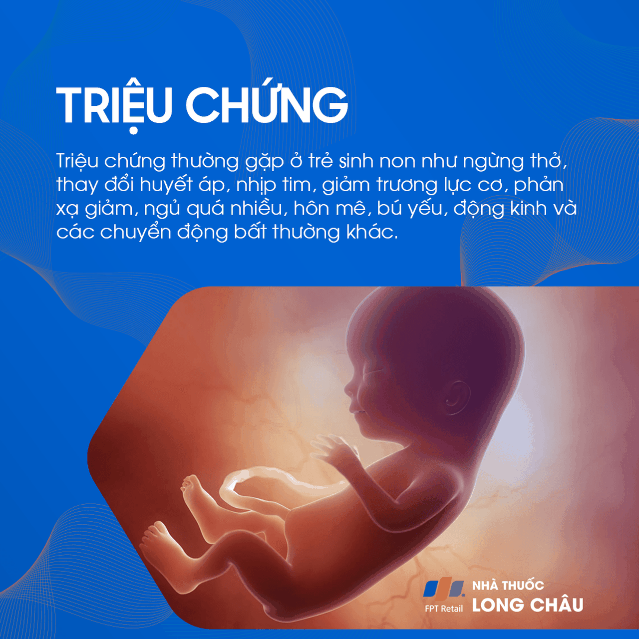 Xuất huyết não thất 4