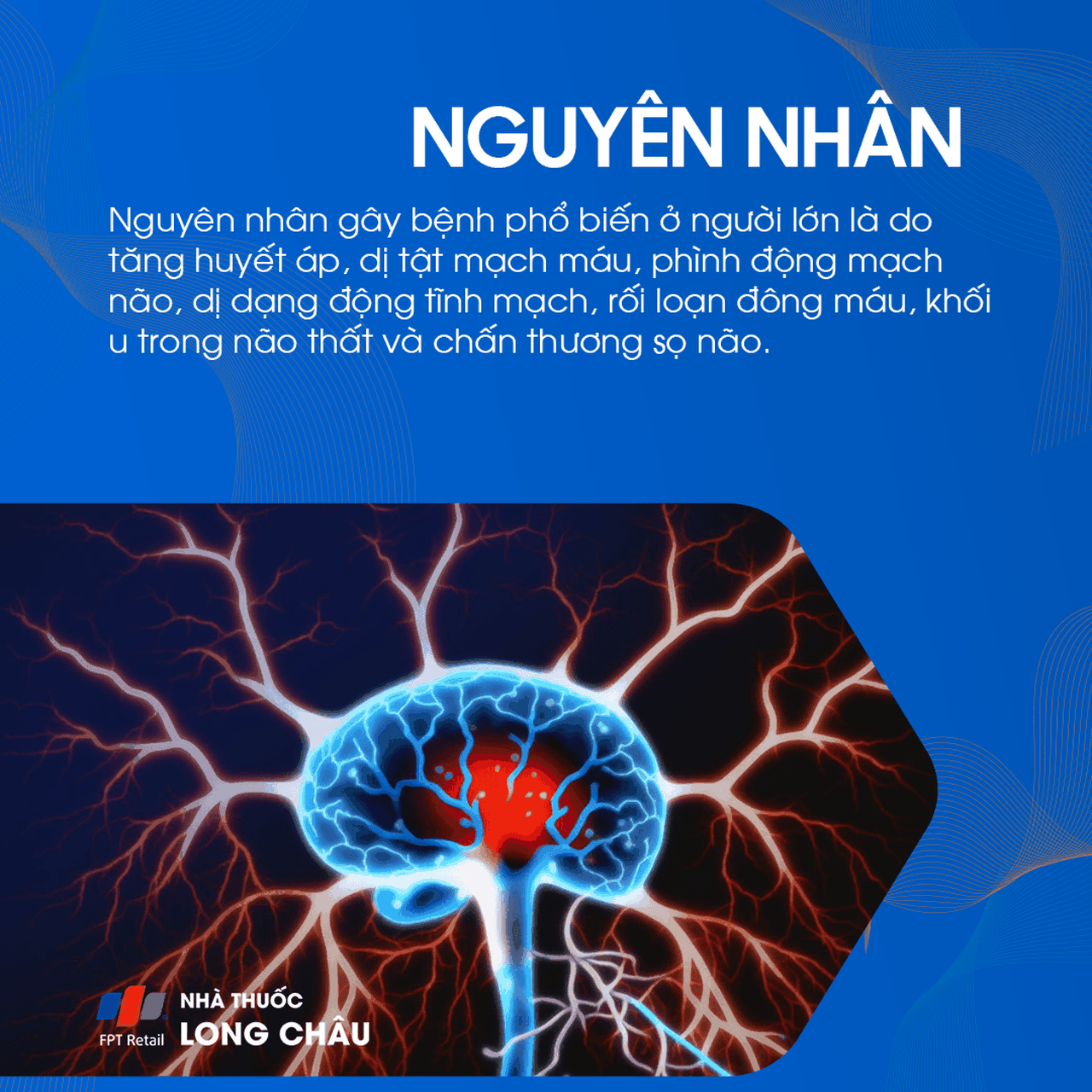 Xuất huyết não thất 4