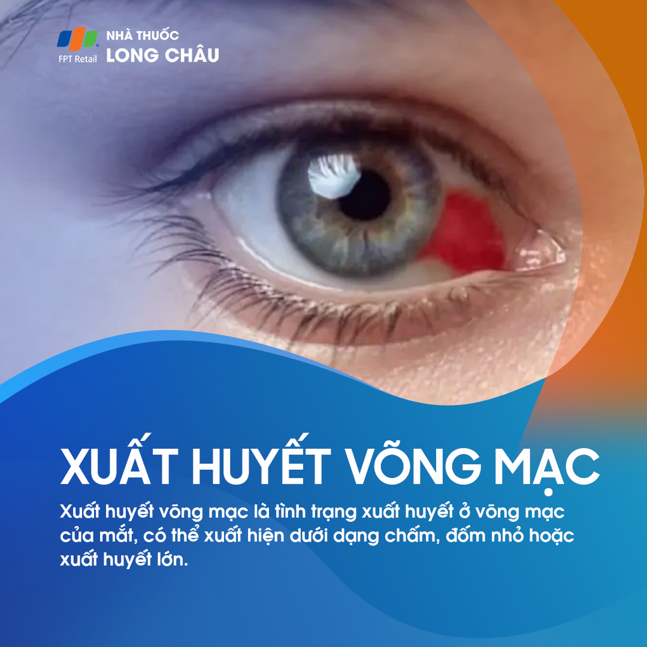 Xuất huyết võng mạc 1