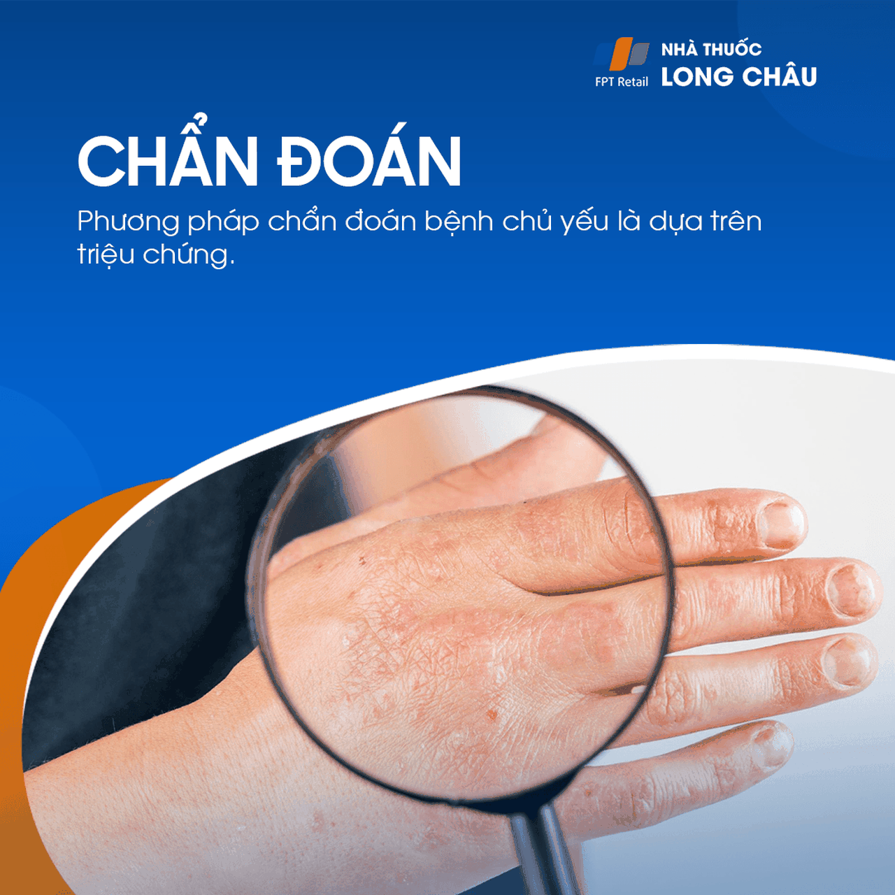 Chẩn đoán á sừng chủ yếu dựa trên triệu chứng lâm sàng