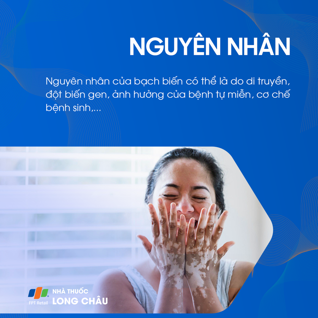Nguyên nhân bạch biến có thể liên quan đến di truyền, đột biến gen hoặc bệnh tự miễn