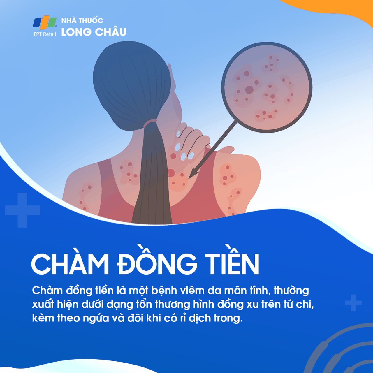 Chàm đồng tiền hay còn được gọi là chàm dạng đĩa hoặc viêm da đồng tiền