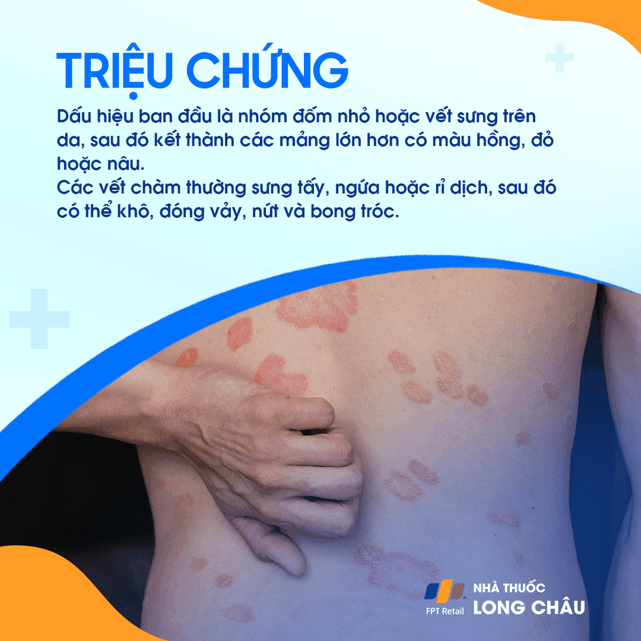 Các vết da bị viêm đỏ, ngứa và có hình tròn hoặc bầu dục, thường xuất hiện trên cánh tay và chân