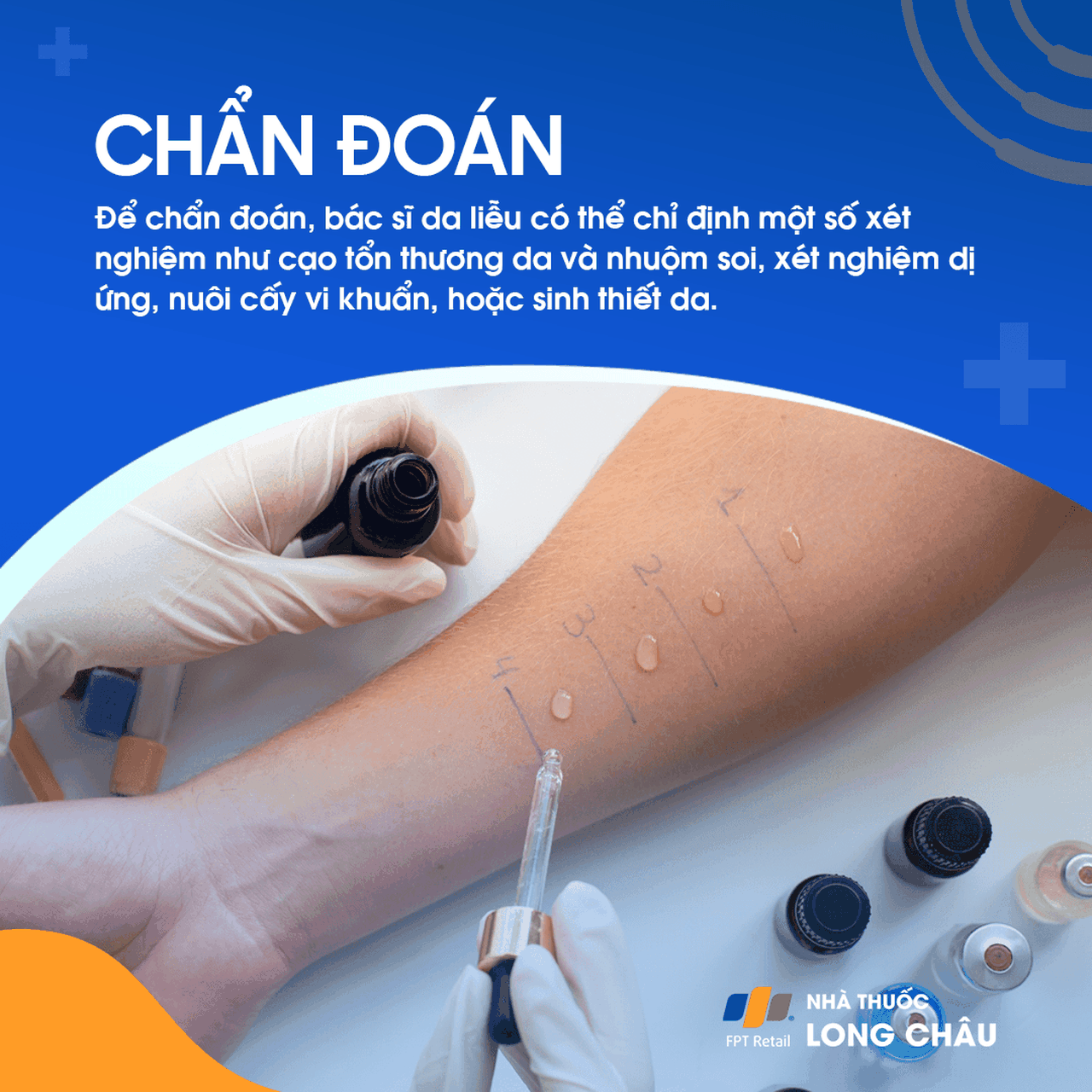 Chẩn đoán thường dựa vào kiểm tra lâm sàng và thử nghiệm da để xác định các yếu tố dị ứng gây ra