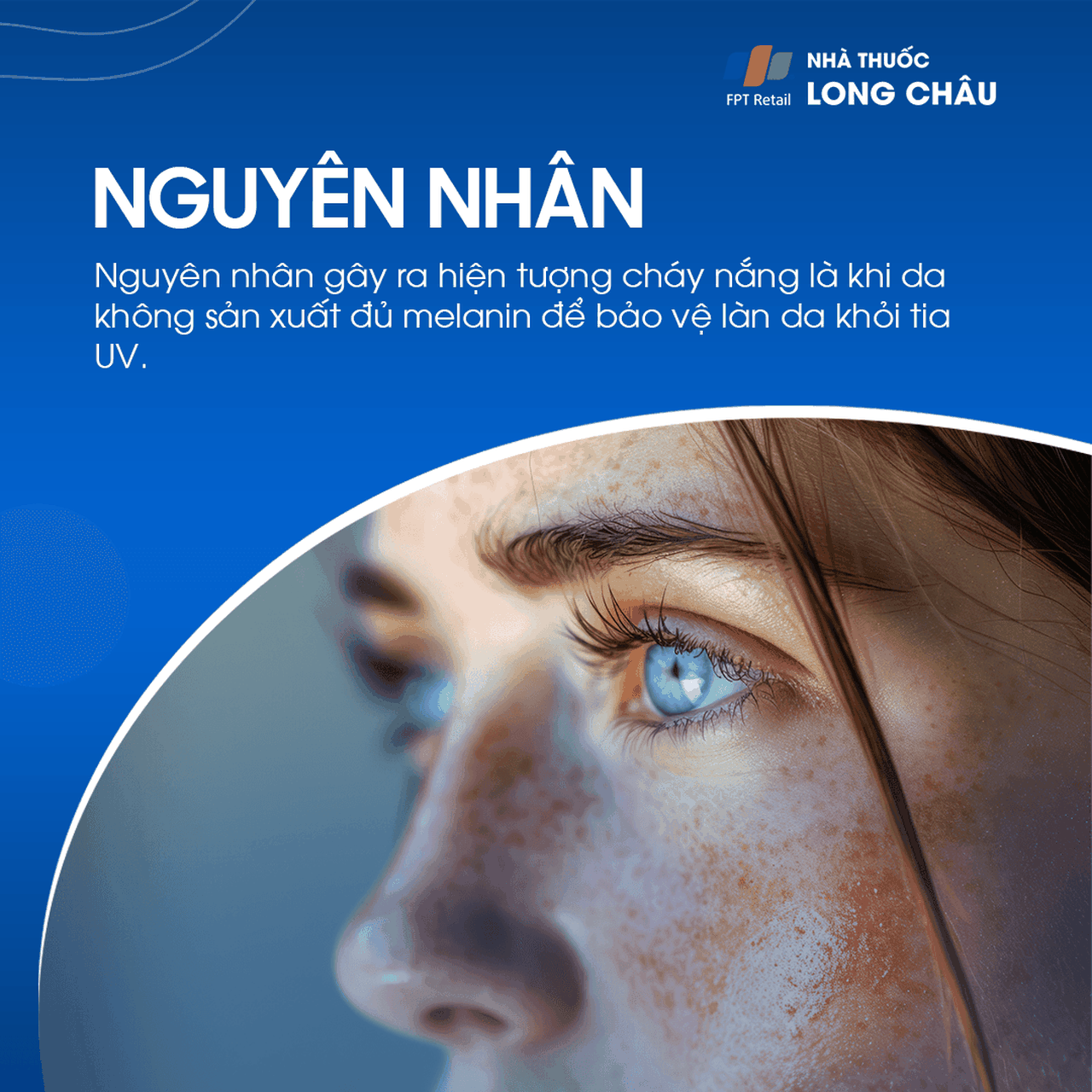 Nguyên nhân cháy nắng thường gặp nhất là do không sử dụng kem chống nắng