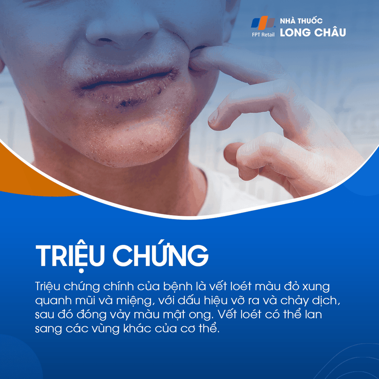 Vết loét đỏ quanh mũi, miệng – dễ vỡ, chảy dịch rồi đóng vảy màu mật ong, có thể lan sang vùng khác