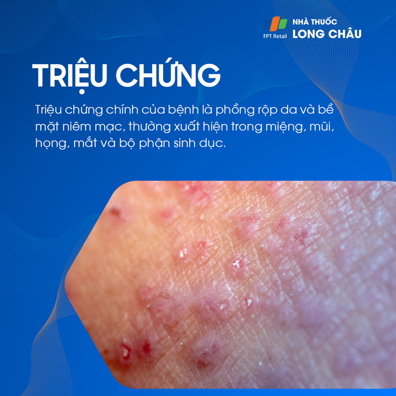 Da bọng nước tự miễn Pemphigus 2