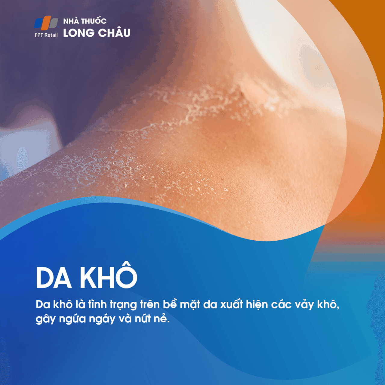 Da khô là tình trạng da bong vảy, gây ngứa và nứt nẻ