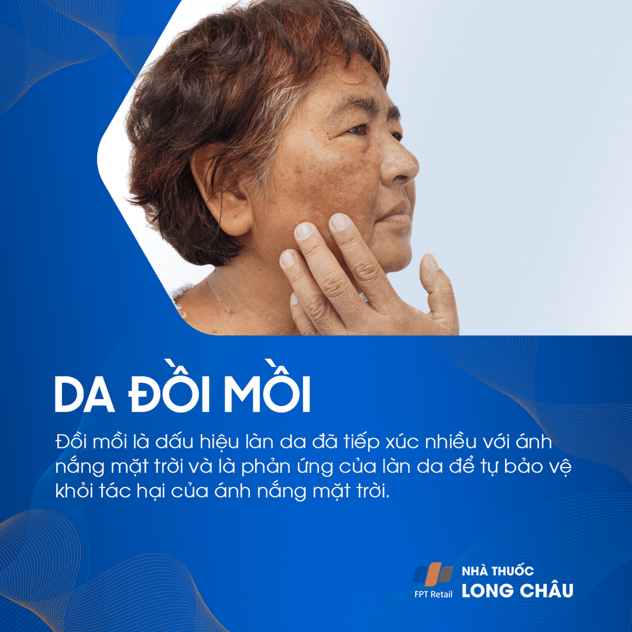 đồi mồi, tình trạng tăng sắc tố da xuất hiện dưới dạng các vết sậm màu trên da