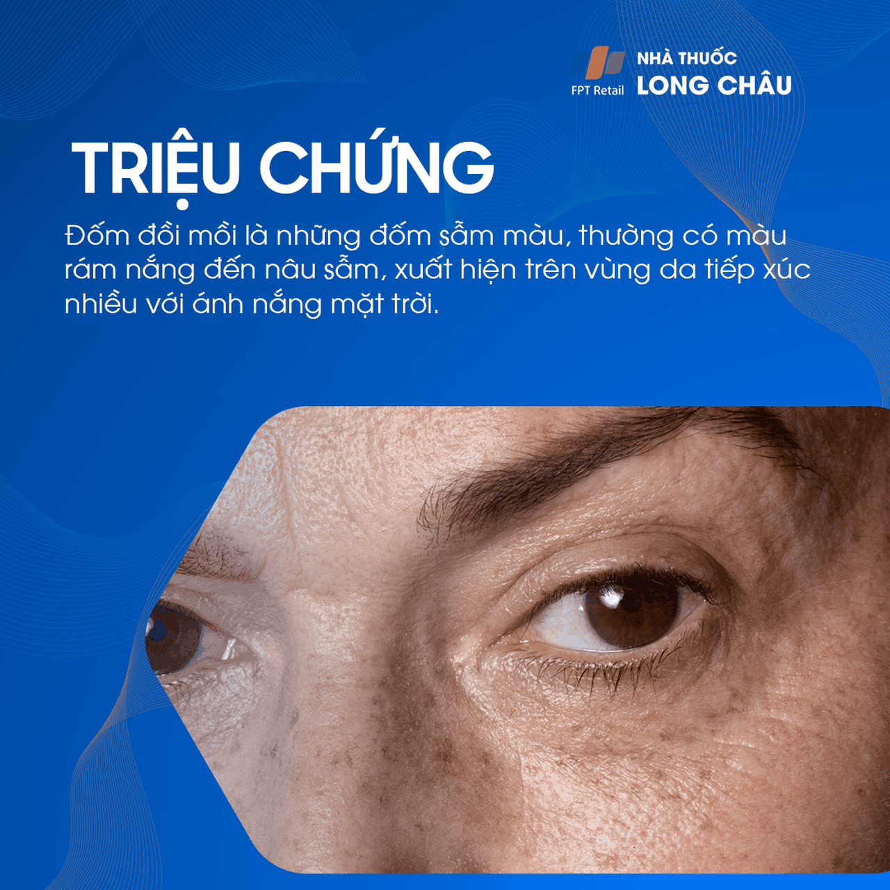 Triệu chứng của đồi mồi thường là sự xuất hiện của các vết nâu hoặc xám trên khuôn mặt, đặc biệt là ở má và trán