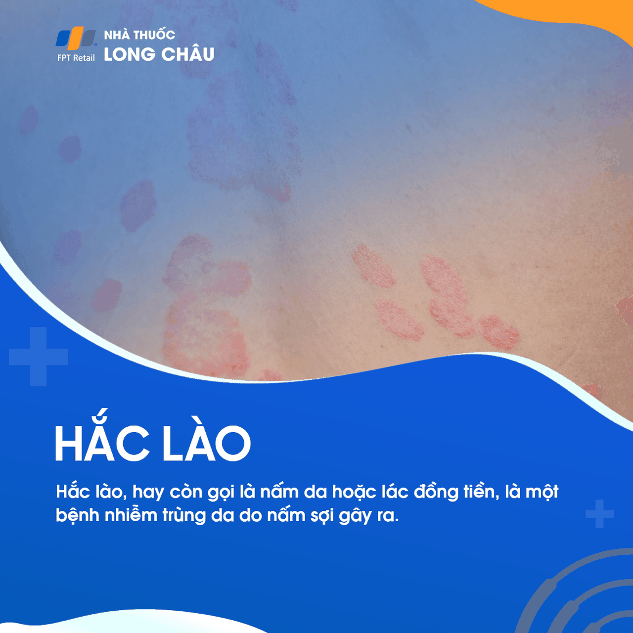 Hắc lào 1