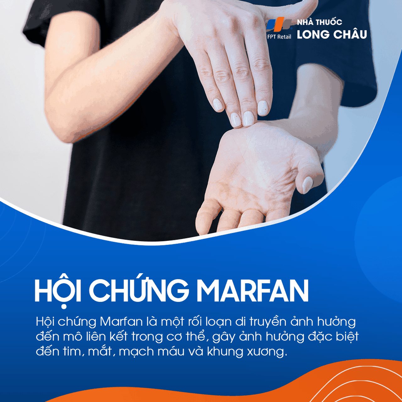 Hội chứng Marfan 1